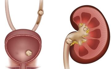 راهنمای جامع پیشگیری و درمان سنگ کلیه: از رژیم غذایی تا علائم هشداردهنده
