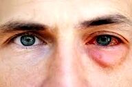  آلرژی چشمی چگونه درمان میشود؟