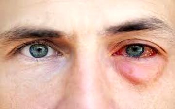  آلرژی چشمی چگونه درمان میشود؟