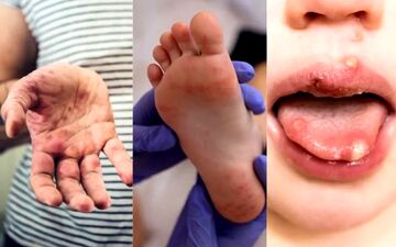 تب برفکی انسان: ویروس مسری و خطرات آن برای کودکان و بزرگسالان