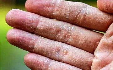 اگر این علائم را دارید به اگزما پوستی دچارید 