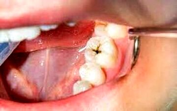 داروهایی که موجب پوسیدگی دندان می‌شوند