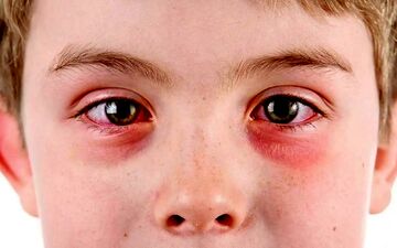 چگونه از شر آلرژی چشمی خلاص شویم؟ 