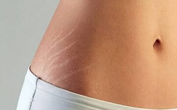 چطور ترک‌های پوستی را از بین ببریم؟