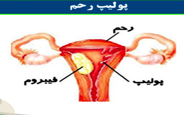پولیپ رحم چیست؟ علت و علائم آن را بدانید