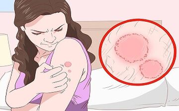قارچ‌های پوستی اذیتت میکنه؟ بیا تا یک روش خانگی نشونت بدم خلاص بشی!