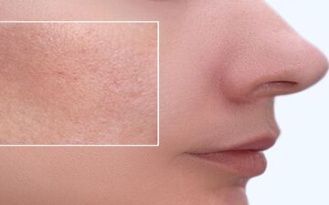 چطوری منافذ باز پوست خود را ببندیم؟