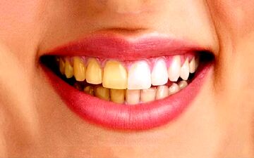  چرا رنگ دندانم تغییر کرد؟