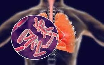 کاهش زمان تشخیص بیماری سل