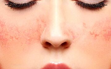 راهنمای جامع مراقبت از پوست های حساس | نکات و راهکارهای مفید برای پوست مشکل‌دار
