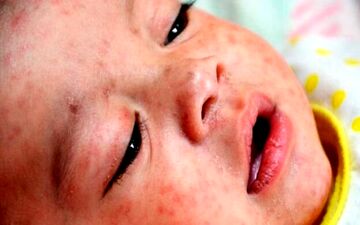 همه‌گیریِ سرخک در بخشی از جزایر اقیانوس آرام
