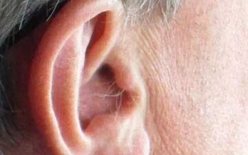 ارتباط شگفت‌انگیز بین موی گوش و حمله قلبی!
