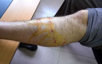 اقدامات مهم بعد از حیوان گزیدگی