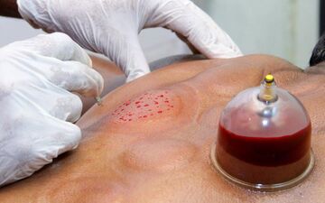 این بیماری‌ها را با حجامت درمان کنید/ بهار؛ بهترین فصل حجامت است؟