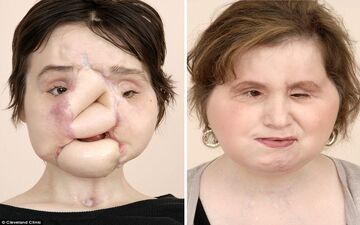عمل پیوند صورت، دختر جوان را به زندگی عادی برگرداند +فیلم 