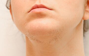 رشد موهای زائد در ۴۰ و ۵۰ سالگی، راه‌حل چیست؟