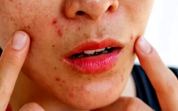 راهنمای سلامت پوست در بهار؛ از مدیریت استرس تا پاکسازی‌های تخصصی

