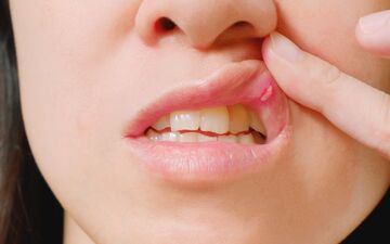 دلایل اصلی بروز آفت‌های مکرر دهان + ویدئو
