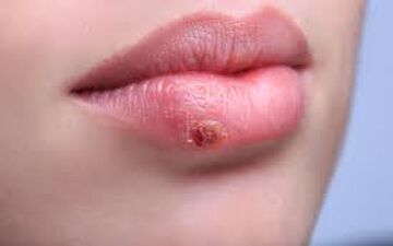 توصیه هایی برای کنار آمدن با تبخال 