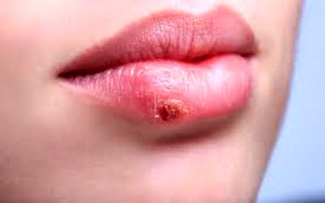 توصیه هایی برای کنار آمدن با تبخال 