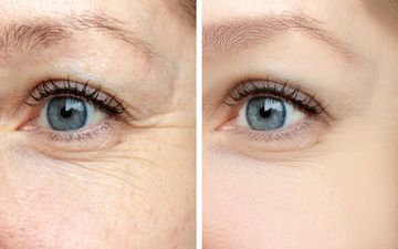 رازهای زیبایی: چگونه چروک‌های دور چشم را از بین ببریم؟
