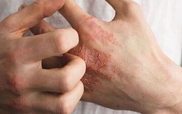 چرا بعضی‌ها بیشتر از بقیه به کهیر مبتلا می‌شن؟ + ویدئو توضیحات