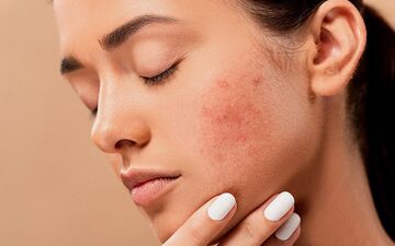 آکنه نشانه چیست؟