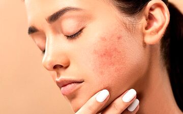 آکنه نشانه چیست؟