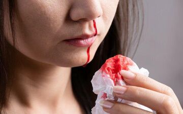 به چه علت خون دماغ می شویم؟