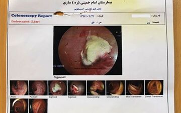 خارج کردن باند استریل بعد 10 سال از بدن بیمار در تهران+ تصاویر عجیب