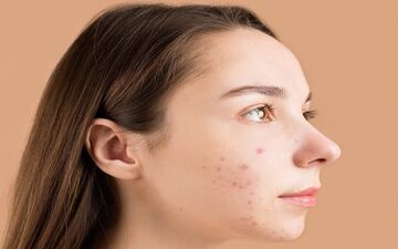 حقیقت مهمی که جوش‌های صورت فاش می‌کنند+تصاویر