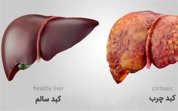 راه نجات کبد چرب