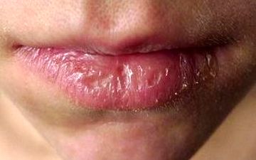از ترک گوشه ی لب ساده نگذرید