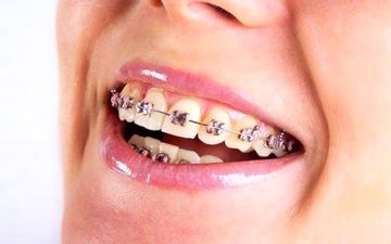  همه انچه باید درباره ارتودنسی بدانید