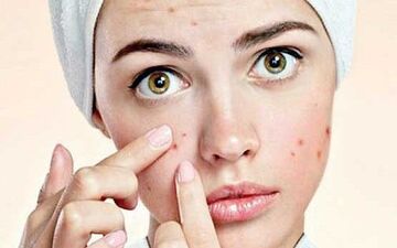 جوش صورت راچکار کنیم؟+ علل و راه‌های درمان 
