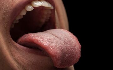 چرا دهان دیابتی ها خشک می شه؟