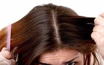 چگونه از شر شوره‌ سر خلاص شویم؟ | راه های درمان شوره سر با این روش تضمینی