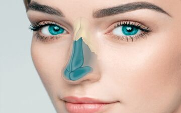 جراحی ترمیمی بینی کوتاه چگونه است؟