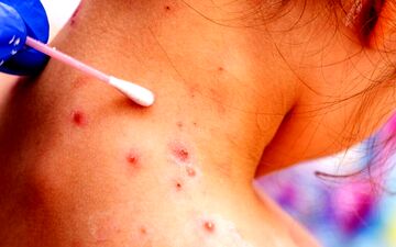 
آیا باید از آبله میمونی بترسی؟