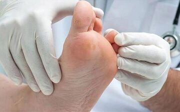 از چالش ها تا راهکارهای درمانی زخم پای دیابتی