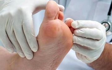 از چالش ها تا راهکارهای درمانی زخم پای دیابتی