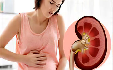 برای جلوگیری از ایجاد سنگ کلیه چه کنیم؟
