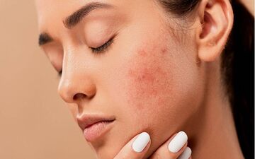 راه های از بین بردن  لک‌های پوستی !