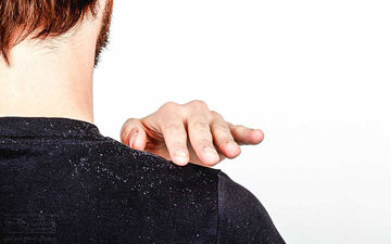 ۵ عامل اصلی شوره سر را بشناسید