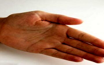 خارش کف دست نشانه چیست؟