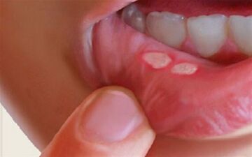 علت و علائم آفت دهان و درمان سریع و خانگی