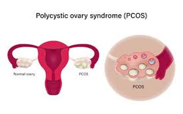 ارتباط PCOS  با کبد چرب