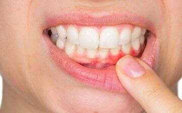 احتمال ابتلا به زوال عقل درصورت داشتن لثه‌های ناسالم 
