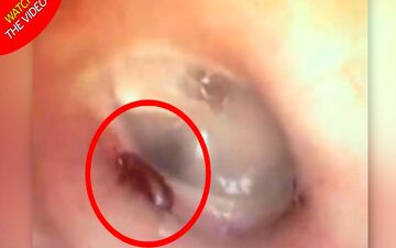 لحظه خارج کردن مورچه از گوش بیمار! +فیلم 