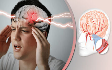 چگونه سکته مغزی را بشناسیم و از مرگ پیشگیری کنیم؟